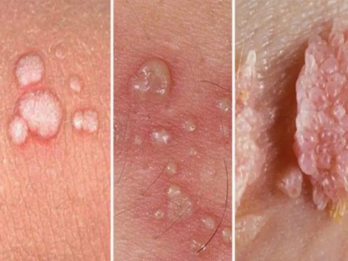 آنچه درباره انواع زگیل باید بدانیم